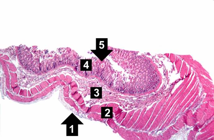 This low-power photomicrograph of intestine shows the normal layers of the intestine, including the serosa (1), the muscularis (2), the submucosa (3), and the mucosal layer (4) with its deep mucosal crypts. There is yet another cystic space within the mucosa (5).