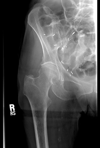 File:Occult hip fracture 001.jpg