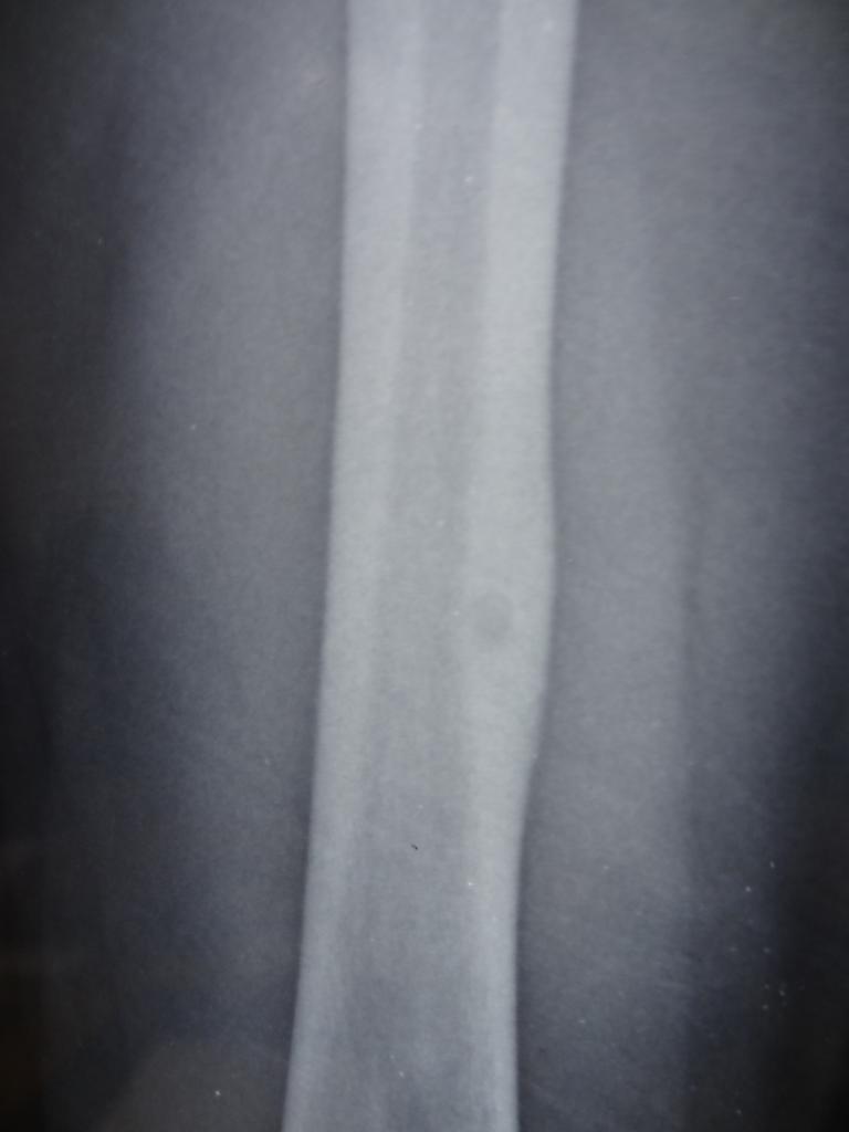 File:Osteoid-osteoma-10.JPG