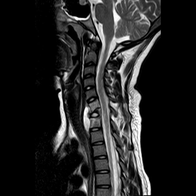 File:Spinal TB MRI 2.jpg