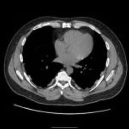 Asbestosis with pleural plaques - Case courtesy of Dr Hani Makky Al Salam, <a href="https://radiopaedia.org/">Radiopaedia.org</a>. From the case <a href="https://radiopaedia.org/cases/45002">rID: 45002</a>