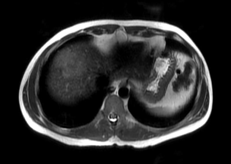 File:Focal nodular hyperplasia MRI 101.jpg