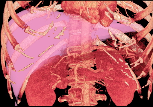 MDCT image. Beautiful 3D image created by MDCT can clearly visualize the liver, measure the liver volume, and plan the dissection plane to facilitate the liver transplantation procedure.