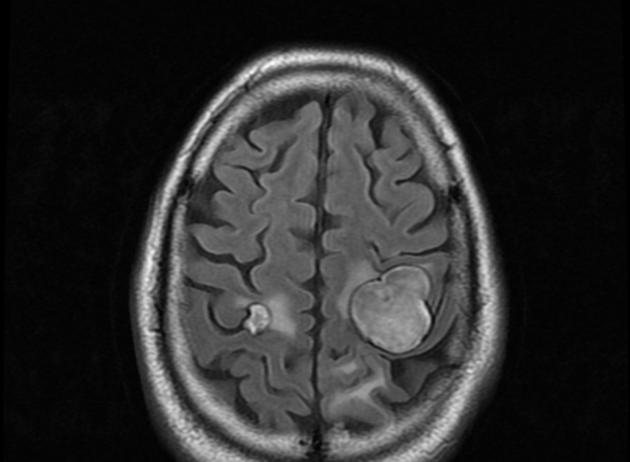 Axial FLAIR MRI head of a 60 year old male with known history of advanced colorectal cancer demonstrates multiple intracerebral metastases.[10]