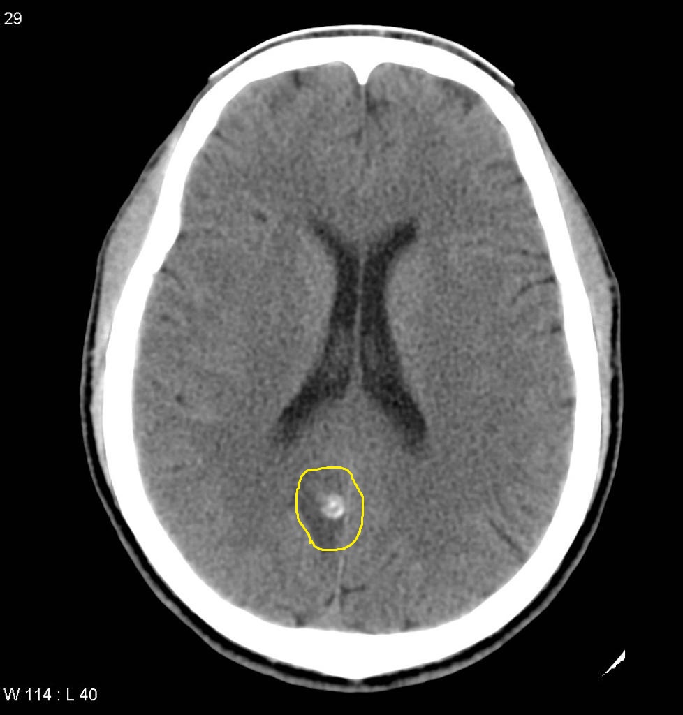File:Neurocysticercosis1.jpg