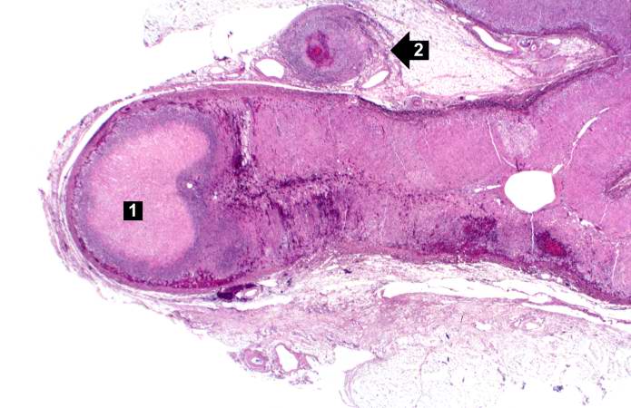 This is a low-power photomicrograph of the adrenal gland. There is an area of necrosis in the adrenal (1) and an affected vessel adjacent to the adrenal (2).