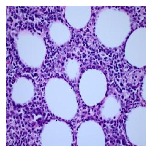 Biopsy of soft tissue : at 40x magnification shows lymphoid infiltrate with abundant cytoplasm.[2]