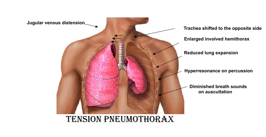 File:Tension pneumothorax .jpg