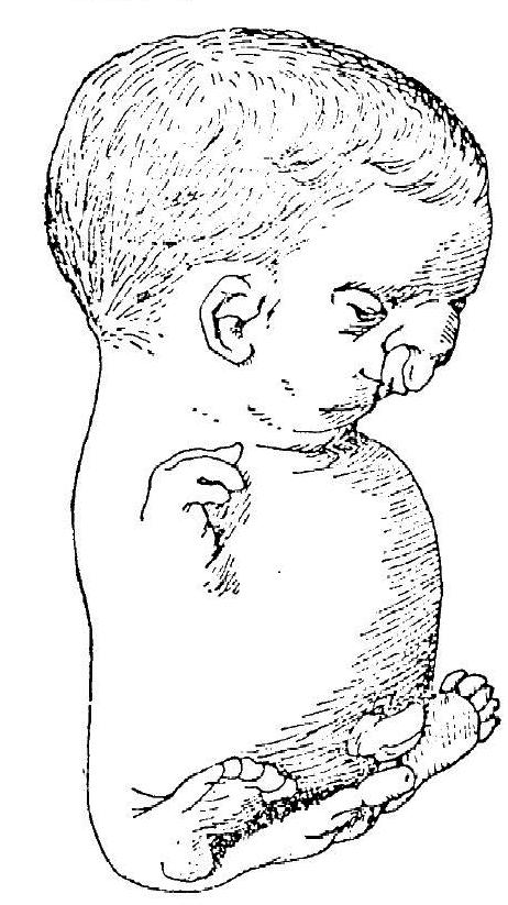 File:Virchow fetus 1898.JPG