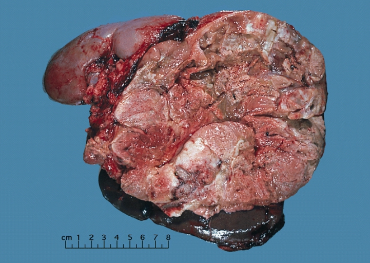 Adrenocortical carcinoma gross pathology, source: By AFIP Atlas of Tumor Pathology - [1], Public Domain, https://commons.wikimedia.org/w/index.php?curid=6719487