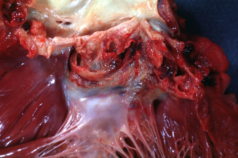 Sinus of Valsalva Aneurysm: Gross; An infected aneurysm with a ruptured aortic cusp due to endocarditis.