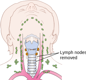 File:Diagram showing after surgery for medullary thyroid cancer with the central lymph nodes and the thyroid gland removed CRUK 092.png