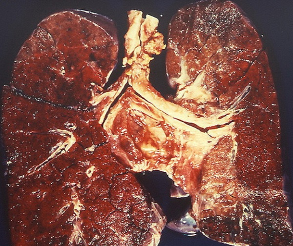 File:Diffuse pulmonary hemorrhage in Goodpasture syndrome.jpg
