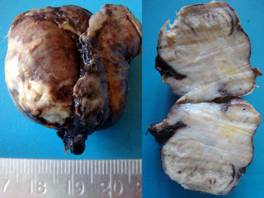 Image on the left shows evidence of acute inflammation and exudates on the surface of the testicle. Image to the right is a cut section showing exudates and dense fibrosis in the epidydimis. Adapted from https://commons.wikimedia.org/wiki/Category:Gross_pathology_of_epididymo-orchitis#/media/File:Acute_epidydimoorchitis_Gross_Pathology.jpg. Accessed on Jan 3rd, 2017.