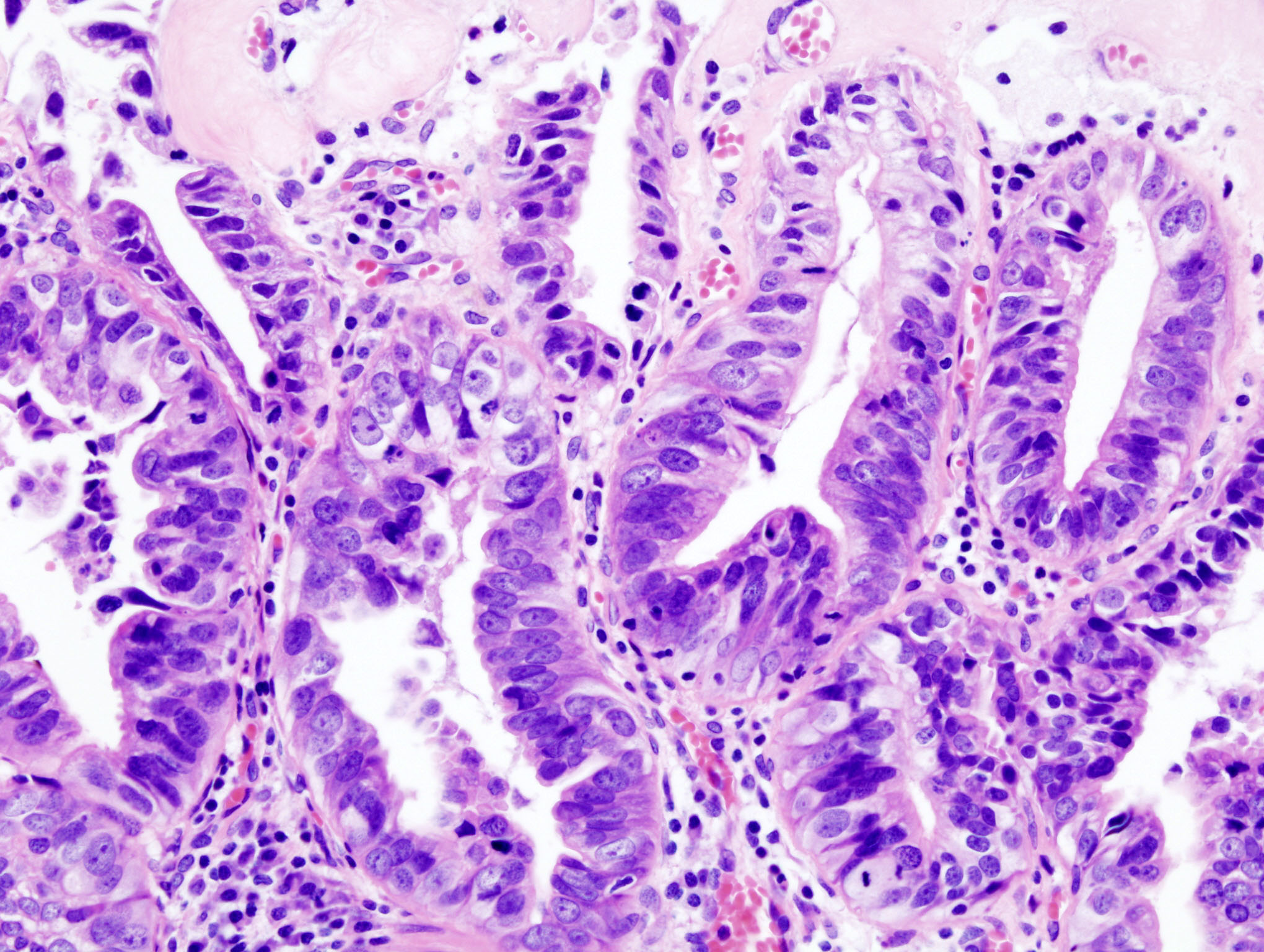 Gallbladder adenocarcinoma histopathology