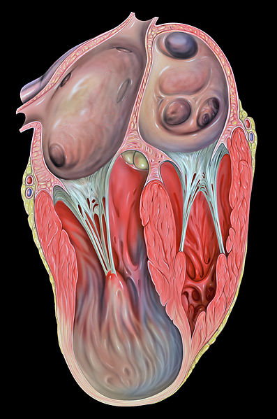 Heart lv aneurysm 4c.jpg