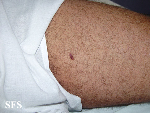 Kaposi's sarcoma. Adapted from Dermatology Atlas.[3]