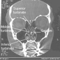 Normal Nose CT Front cross section