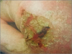 Superficial squamous cell carcinoma on the hand