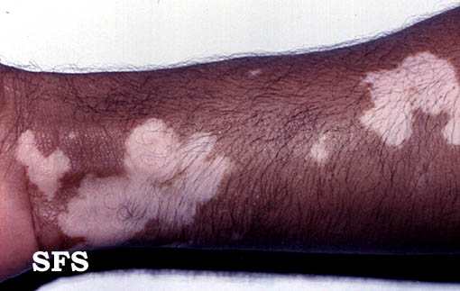 Image description. Adapted from Dermatology Atlas[5]