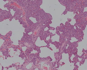 File:Intravascular large B-cell lymphoma pathophysiology image 5.jpg