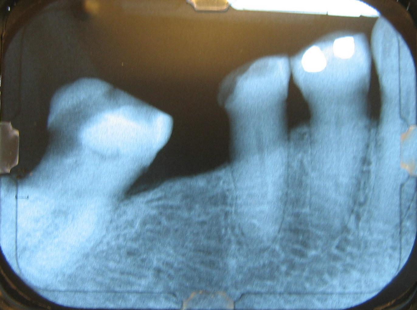 This X-ray film reveals some bone loss in the lower right mandible. The associated teeth exhibit poor crown-to-root ratios and may be subject to secondary occlusal trauma.