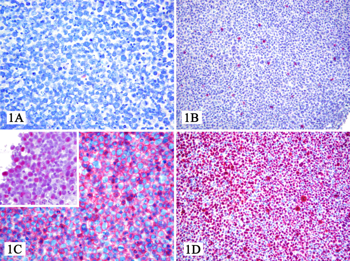 File:Microscopic pathology of primary effusion lymphoma.jpg