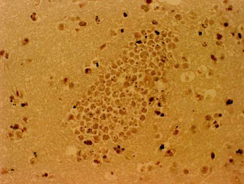 A section of the brain stained with hematoxylin and eosin, of a PAM patient showing a large cluster of Naegleria fowleri trophozoites. Cysts are not seen.