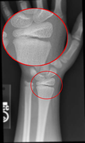 Salter-Harris fracture-IImage courtesy of RadsWiki and copylefted