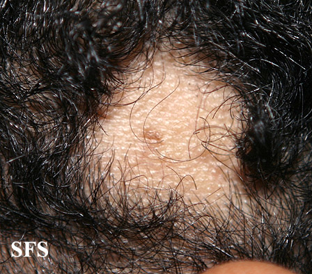 Alopecia acquisitum centrifugum. Adapted from Dermatology Atlas.[4]