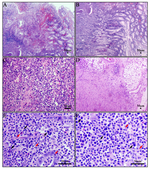 File:Enteropathy-associated T-cell lymphoma Image A.jpg
