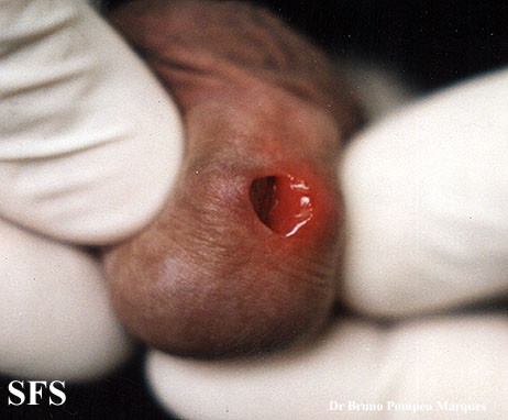 File:Herpes simplex 16.jpeg