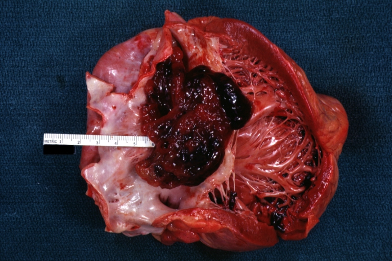 Myxoma: Gross natural color (outstanding) photo of intact large left atrial myxoma with atrium and left ventricle opened in usual way