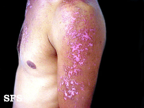 Lupus erythematosus chronicus disseminatus superficialis. Adapted from Dermatology Atlas.[9]