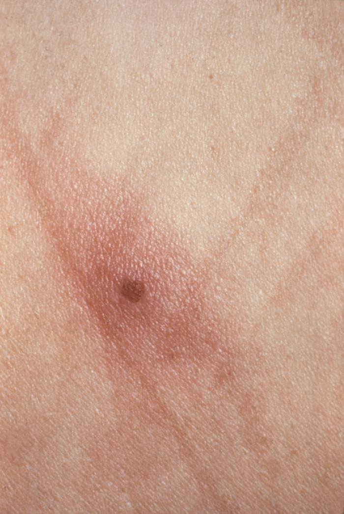 This was a skin lesion on a patient with gonorrhea due to the systemic spread of N. gonorrhoeae bacteria.Gonorrhea is caused by Neisseria gonorrhoeae. If left untreated, will enter the blood, thereby, spreading throughout the body. As is shown here, such full body dissemination may manifest itself as skin lesions throughout the body.Adapted from CDC