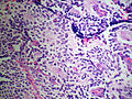 Adrenal neuroblastoma[6]