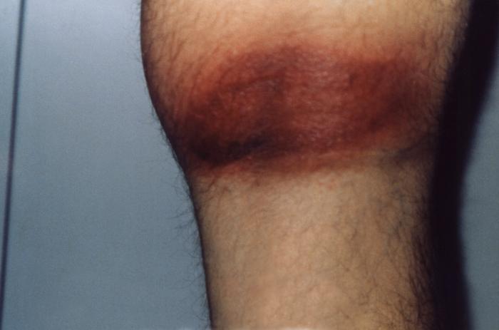 Posterior knee with the erythema migrans (EM) rash characteristic of what was diagnosed as Lyme disease, caused by the bacterium, Borrelia burgdorferi. From Public Health Image Library (PHIL). [2]