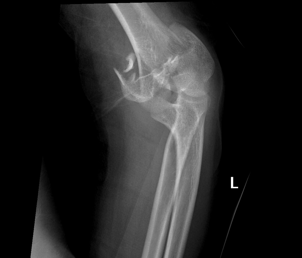Condylar and supracondylar fracture of the elbow.