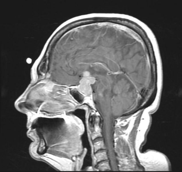 There is a well defined homogeneously enhancing lesion in the pituitary fossa on Sagittal T1 C+ suggestive of pituitary adenoma.[2]