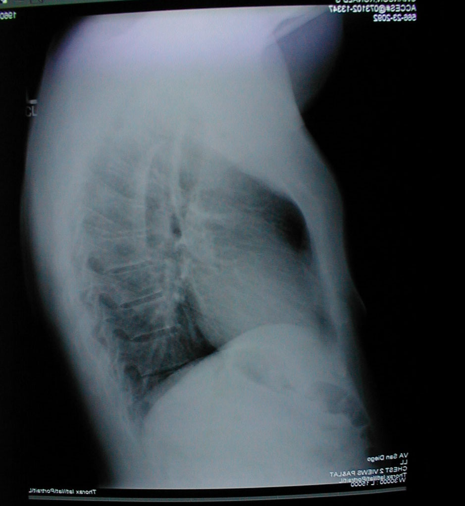The lateral chest x-ray shows a subtle concave appearance of the lower sternum.