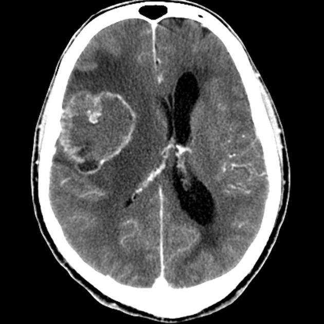 File:CT scan of brain metastasis 5.jpg