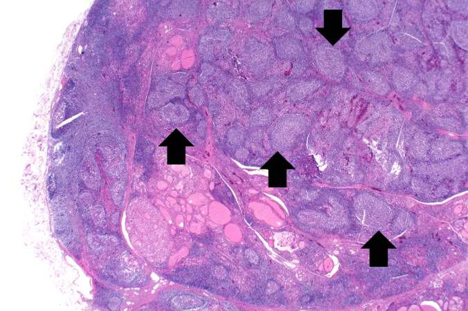 This is another view of thyroid gland filled with inflammatory cells forming germinal centers (arrows).