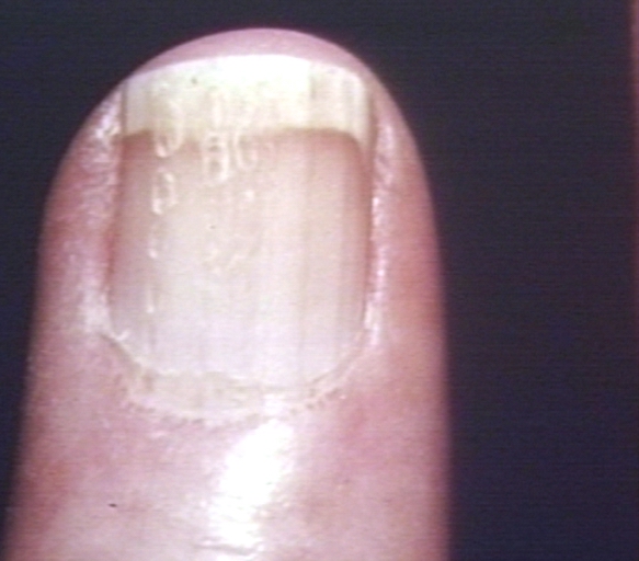 Hand: Scleroderma, finger, posterior nail fold Source:Images courtesy of Professor Peter Anderson DVM PhD and published with permission © PEIR, University of Alabama at Birmingham, Department of Pathology [7]