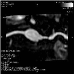 File:Renal artery stenosis 011.jpg