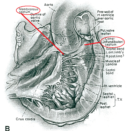 File:Anatomy of normal septum as seen from RV side (e).png