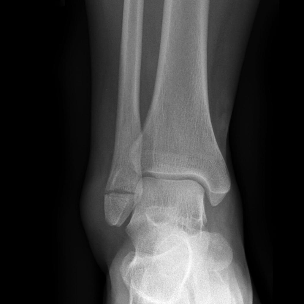 Ankle-fracture-weber A