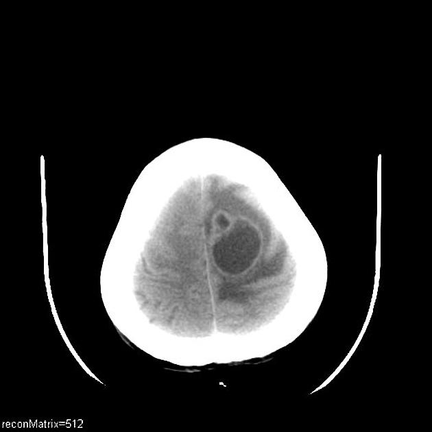 File:CT scan of brain metastasis 6 noncontrast.jpg