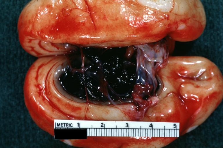 Brain: Intraventricular Hemorrhage In Newborn: Gross natural color separated cerebral hemispheres with removed septum pellucidum showing ventricle filled with blood