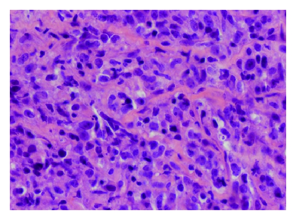 File:Primary mediastinal large B-cell lymphoma pathology .jpg