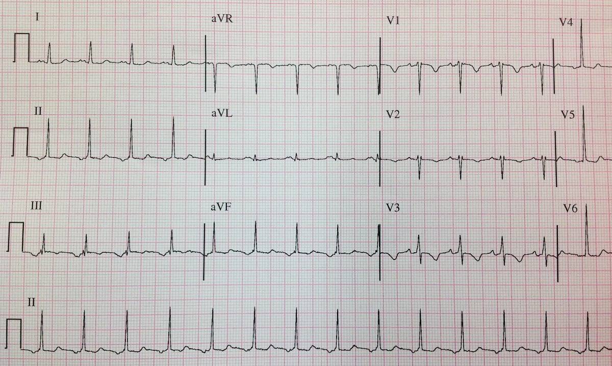 Inverted P waves in inferior leads